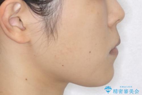 前歯のがたつきとオープンバイト:インビザラインでまとめて治すの治療前(顔貌)