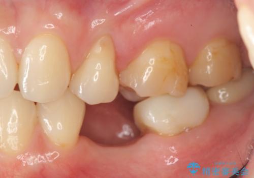 乳歯がぐらついてきた インプラントを用いた機能回復の治療前