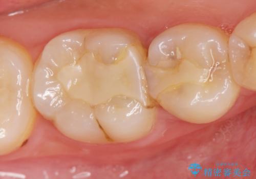 歯が黒くなってきた　虫歯のセラミック治療の症例 治療前