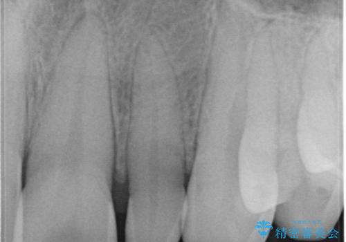 【オールセラミッククラウン】矮小歯の治療の治療前