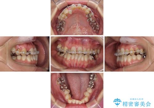 急速拡大装置 前歯の反対咬合をインビザラインで改善の治療後
