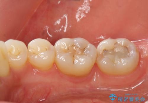 [ 歯周病 ]　歯を残す再生治療の治療後