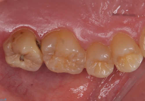 奥歯の放置した虫歯 セラミックでの治療の治療前