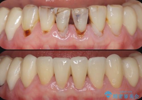 シェーグレン症候群で多発した虫歯 前歯のセラミック治療