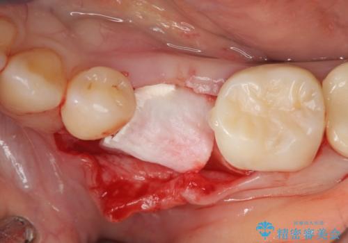 乳歯がぐらついてきた インプラントを用いた機能回復の治療中