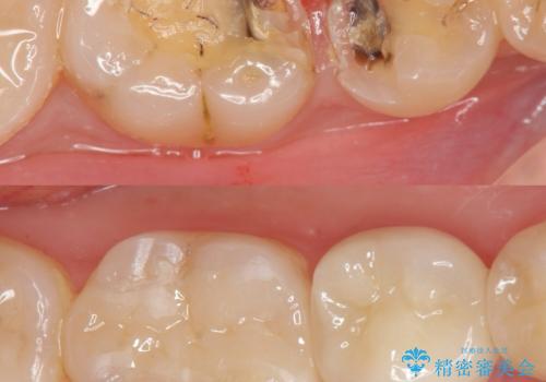 歯が黒くなってきた　虫歯のセラミック治療