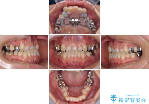 急速拡大装置 前歯の反対咬合をインビザラインで改善の治療前
