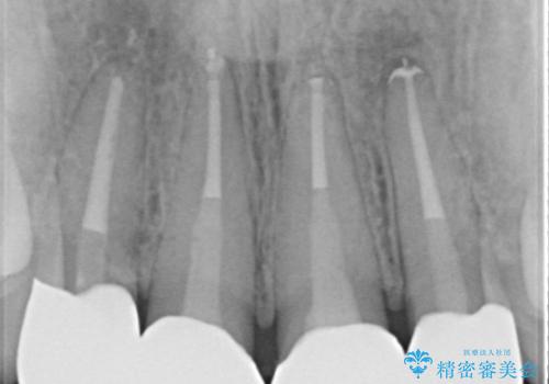 【精密根管治療+オールセラミッククラウン】より自然な前歯にしたい!の症例 治療後