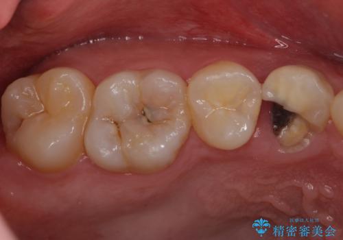 保険治療では抜歯適応になる歯　抜歯せずに保存(エクストリュージョン)の治療前