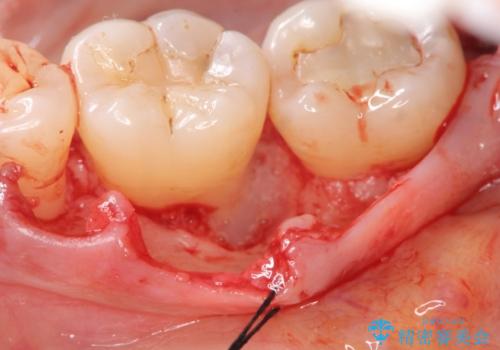 [ 歯周病 ]　歯を残す再生治療の治療前