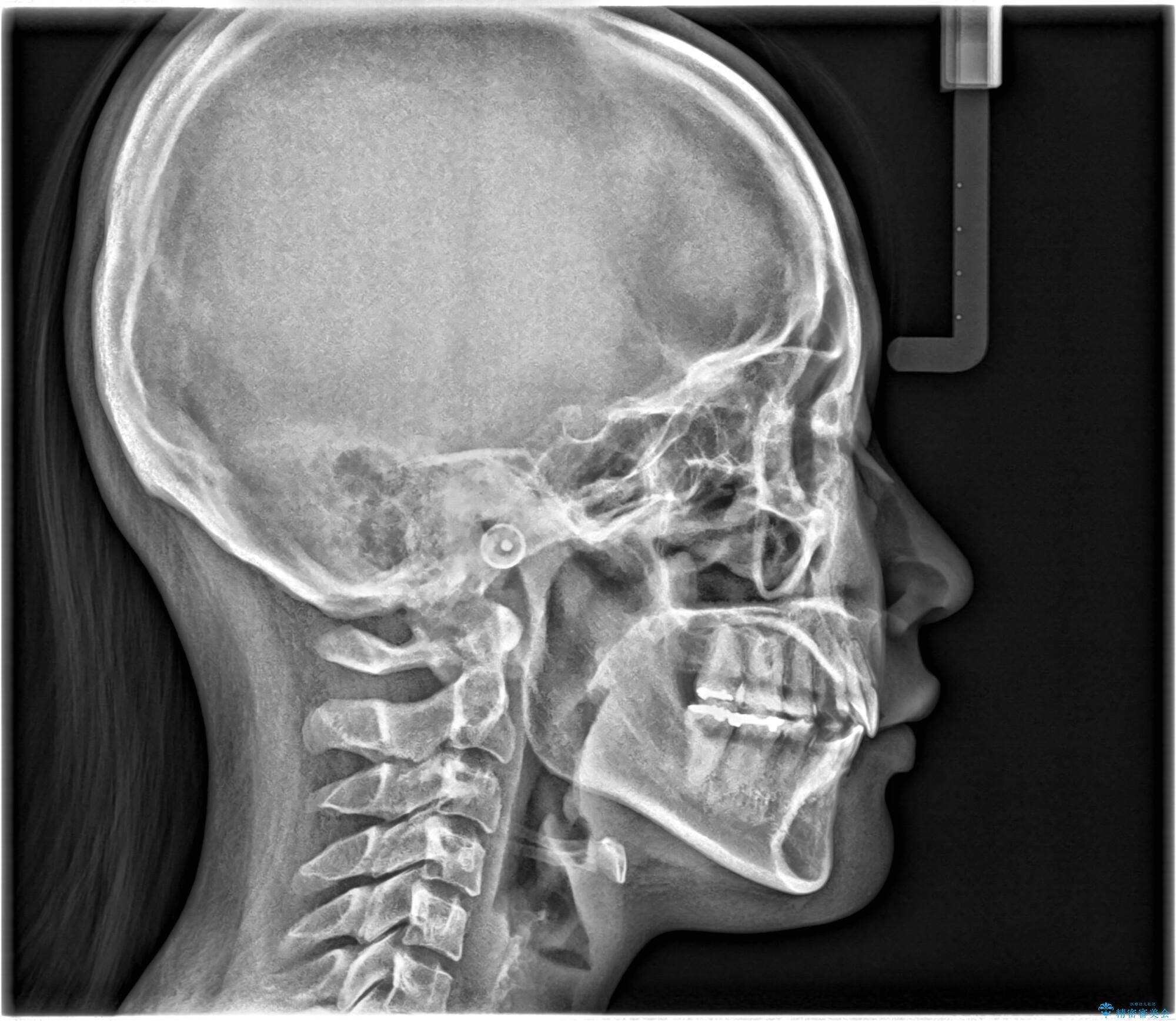 【抜歯矯正】口元を下げたい!の治療後(顔貌)