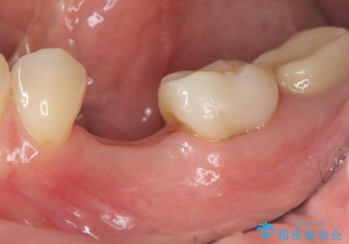 乳歯がぐらついてきた インプラントを用いた機能回復の治療前