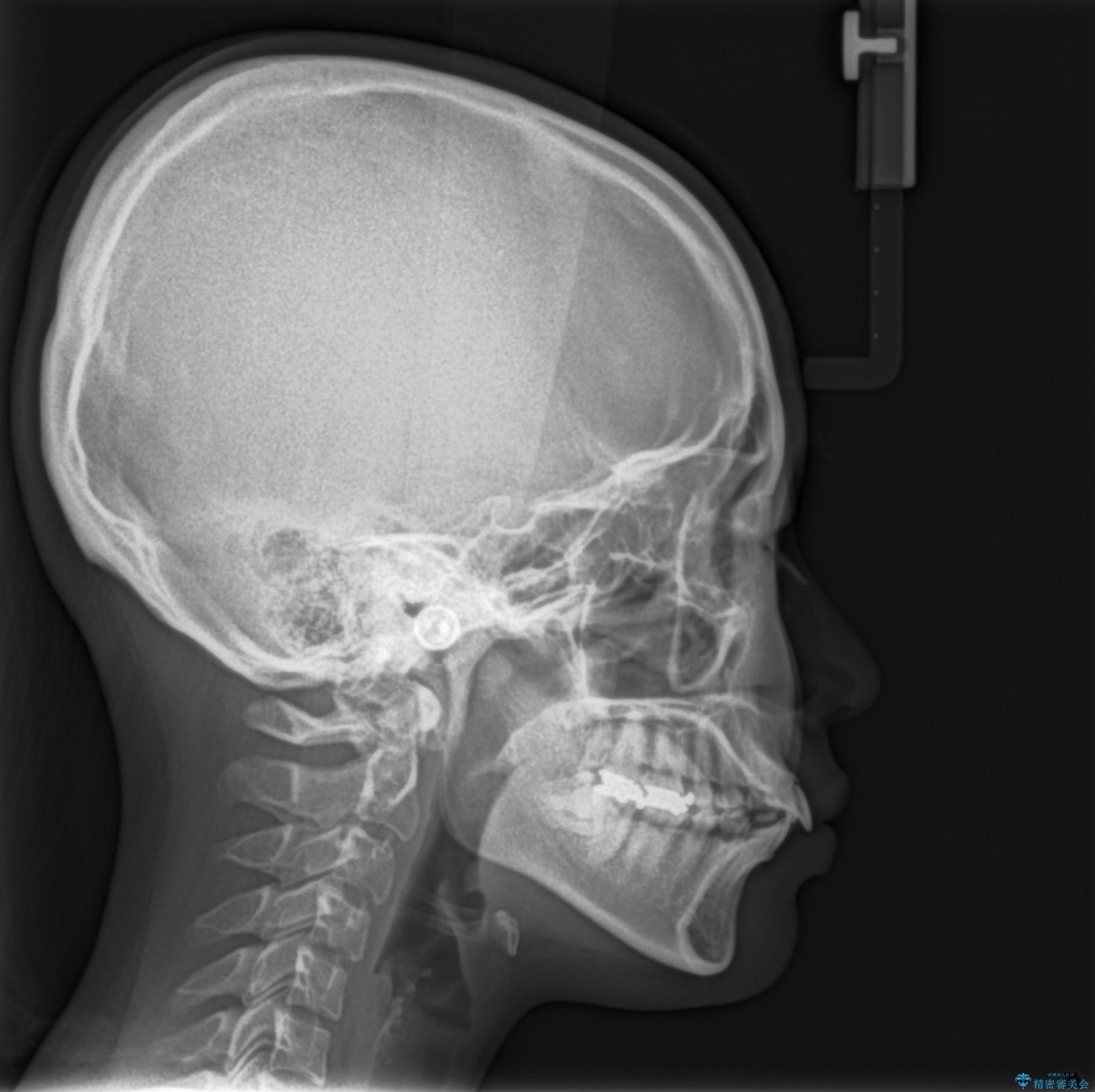 【抜歯矯正】口元を下げたい!の治療前(顔貌)