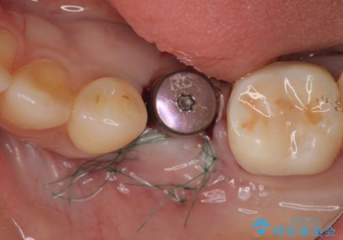 乳歯がぐらついてきた インプラントを用いた機能回復の治療中