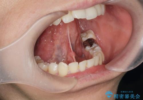 [ 舌小帯の形成 ]  滑舌を改善したいの症例 治療前
