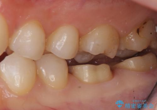 変色した樹脂の詰め物 セラミックでのやり替えの治療中