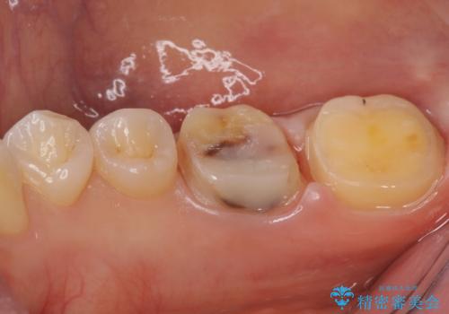 変色した樹脂の詰め物 セラミックでのやり替えの治療中