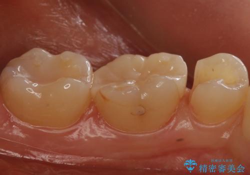 歯と歯の間の虫歯 セラミックインレーでの治療の治療中