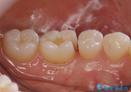奥歯の虫歯 セラミックインレーでの治療の治療中