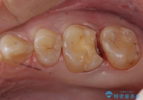 歯と歯の間に隠れた虫歯　セラミックインレーによる治療の治療中