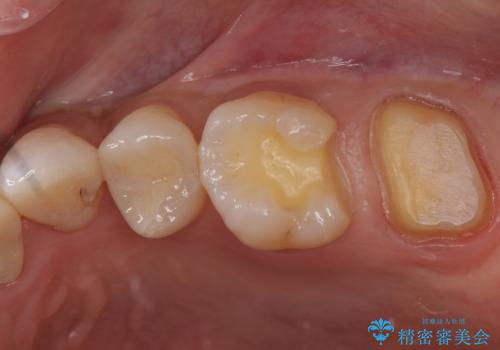 樹脂の詰め物をセラミックで修復の治療中