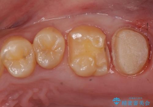 奥歯の放置した虫歯 セラミックでの治療の治療中