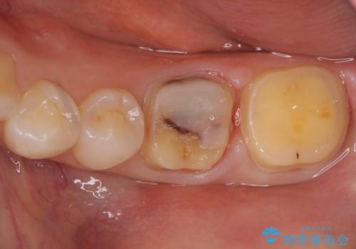 変色した樹脂の詰め物 セラミックでのやり替えの治療中