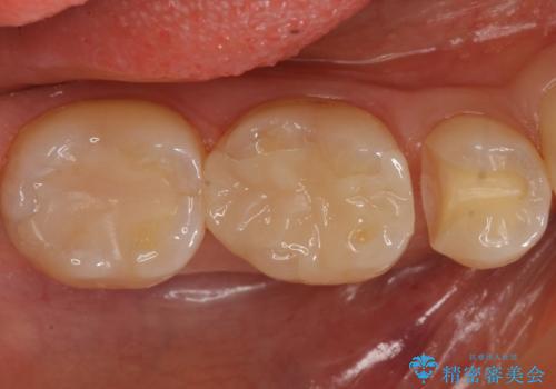 歯と歯の間の虫歯 セラミックインレーでの治療の治療中