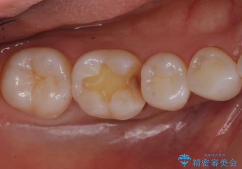 奥歯の虫歯 セラミックインレーでの治療の治療中