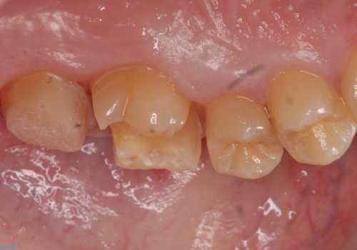 奥歯の放置した虫歯 セラミックでの治療の治療中