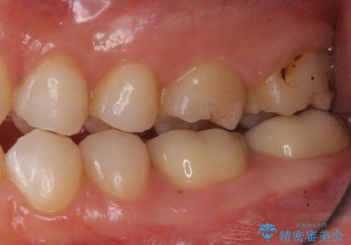 変色した樹脂の詰め物 セラミックでのやり替えの治療後