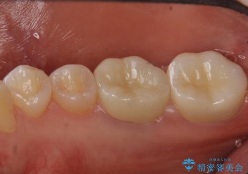 変色した樹脂の詰め物 セラミックでのやり替えの治療後