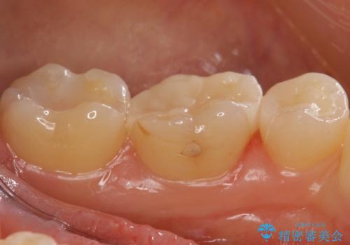 歯と歯の間の虫歯 セラミックインレーでの治療の治療後