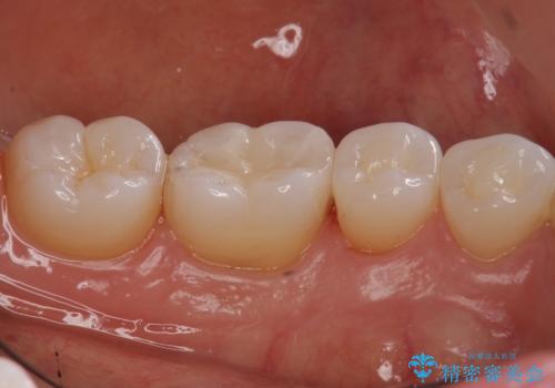 奥歯の虫歯 セラミックインレーでの治療の治療後