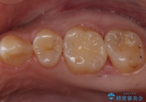 歯と歯の間に隠れた虫歯　セラミックインレーによる治療の症例 治療後