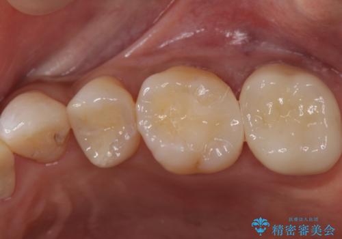 樹脂の詰め物をセラミックで修復の治療後