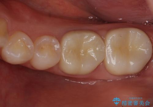 変色した樹脂の詰め物 セラミックでのやり替えの治療後