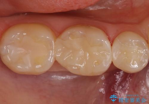 歯と歯の間の虫歯 セラミックインレーでの治療の治療後