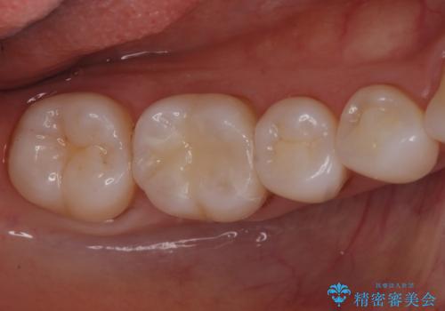 奥歯の虫歯　セラミックインレーでの治療の治療後