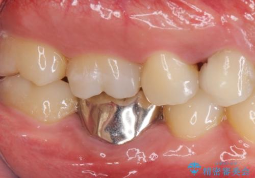 保険治療では抜歯適応になる歯　抜歯せずに保存(エクストリュージョン)の治療前