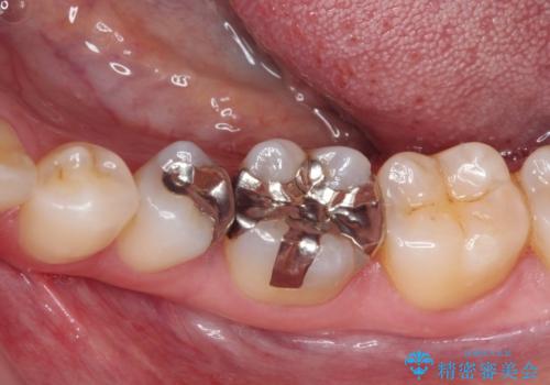 銀歯をセラミックにしたい セラミックインレー修復の治療前