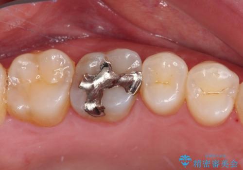 銀歯をセラミックにしたい セラミックインレー修復の治療前