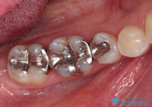 銀歯をセラミックにしたい セラミックインレー修復の治療前