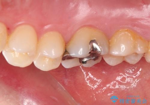 銀歯をセラミックにしたい セラミックインレー修復の治療前