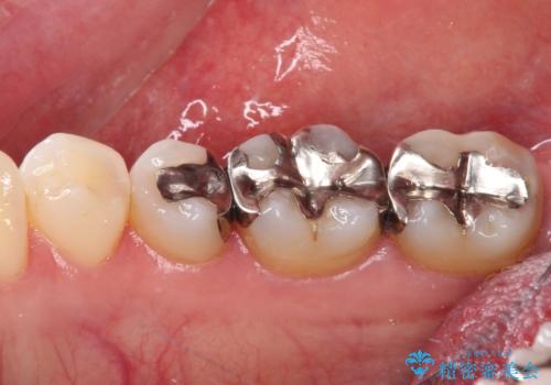 銀歯をセラミックにしたい　セラミックインレー修復の治療前