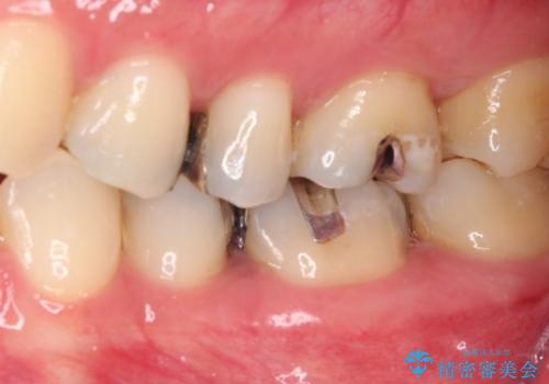 銀歯をセラミックにしたい セラミックインレー修復の治療前