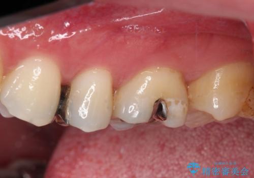 銀歯をセラミックにしたい セラミックインレー修復の治療前