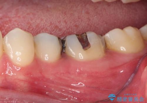 銀歯をセラミックにしたい セラミックインレー修復の治療前