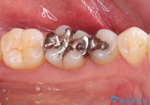 銀歯をセラミックにしたい セラミックインレー修復の治療前