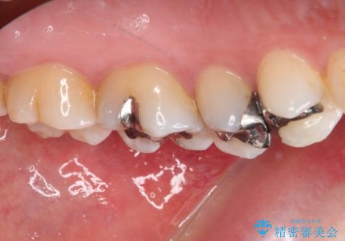 銀歯をセラミックにしたい セラミックインレー修復の治療前